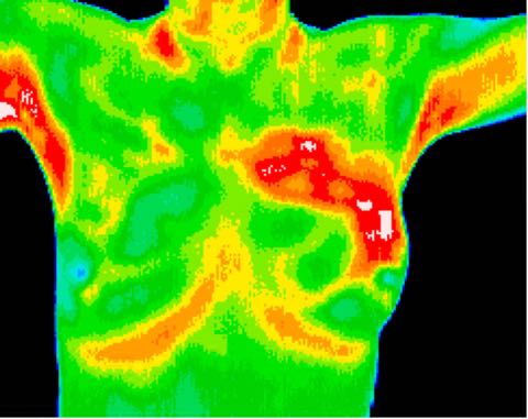 Ductal carcinoma in situ (DCIS) in upper left breast