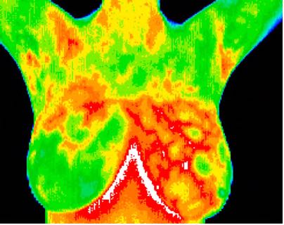 Fibrocystic changes in left breast