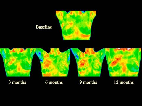 DCIS was not detectable by mammogram until final image