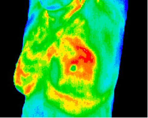 Mastitis (infection)
